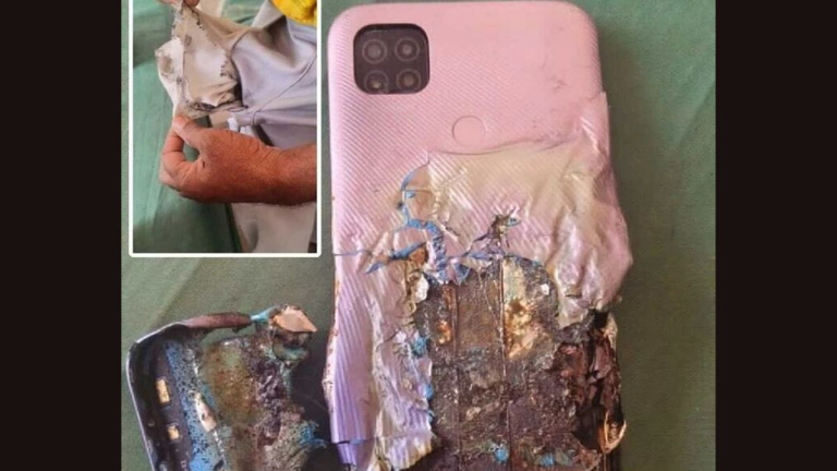 Mobile Phone Explodes: ప్యాంటు జేబులో ఒక్కసారిగా పేలిన సెల్ ఫోన్, జేబు కాలిపోవడంతో పాటు..