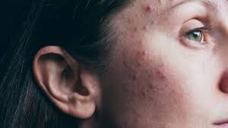 Health Tips: ముఖం పైన మచ్చలు, మొటిమలు సమస్యతో బాధపడుతున్నారా..ఈ చిట్కాతో మీ చర్మం కాంతివంతంగా మారుతుంది.