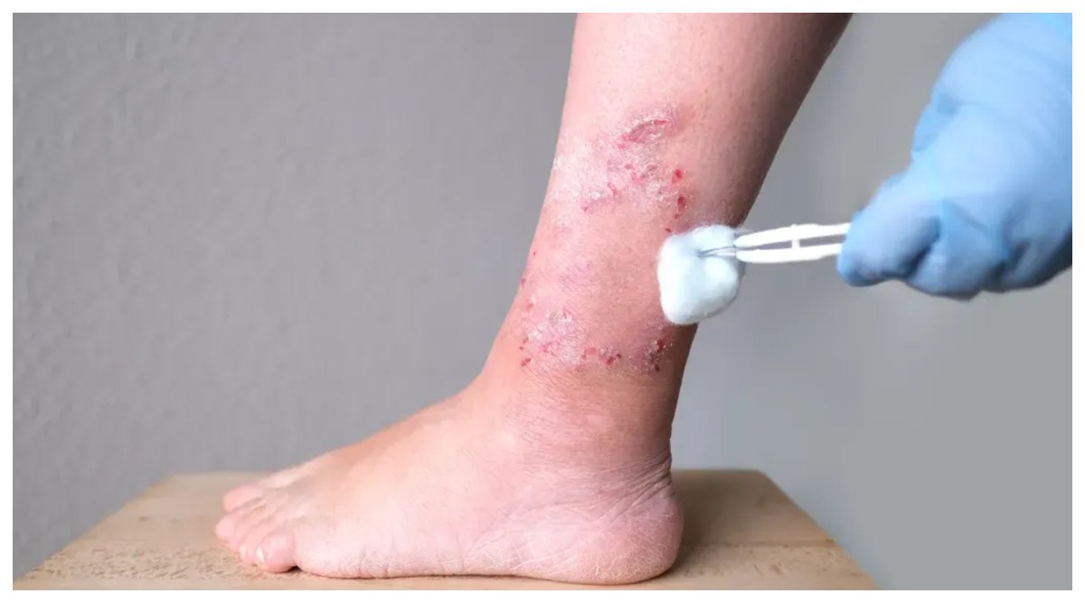 Diabetic Wound Treatment: మధుమేహం రోగులకు గుడ్ న్యూస్, పాదాలకు అయ్యే పుండ్లకు చెక్, గాయాలను వేగంగా మాన్పే సహజ సిద్ధ ఔషధాన్ని కనిపెట్టిన నాగాలాండ్ విశ్వవిద్యాలయ పరిశోధకులు