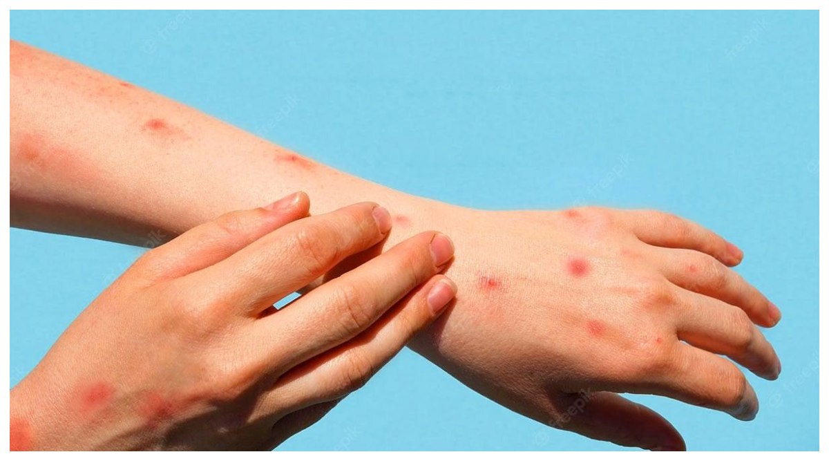 Tomato Virus: టొమాటో వైరస్ అంటే ఏమిటి ? ఈ వ్యాధి ఎలా వస్తుంది, దీనికి చికిత్స ఏమైనా ఉందా, ఎలాంటి జాగ్రత్తలు తీసుకోవాలి
