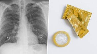 Condom in Lungs: పురుషాంగం చీకుతూ కండోమ్ మింగేసిన భార్య, అది ఊపిరితిత్తులకు చేరడంతో మొదలైన టీబీ లక్షణాలు, ఆపరేషన్ ద్వారా కండోమ్ తొలగించిన వైద్యులు