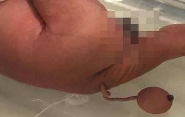 Baby With Tail: తోకతో పుట్టిన శిశువు, బ్రెజిల్‌లో జన్మించిన బాలుడికి 12 సెం.మీ పొడవైన తోక, ఆశ్చర్యానికి గురైన వైద్యులు, గద ఆకారంలో శిశువుకు తోక