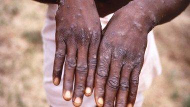 Monkeypox in US: అమెరికాలో తొలి మంకీపాక్స్ కేసు, వ్యాధి సోకిన వ్య‌క్తి శ‌రీరాన్ని తాకితే ఈ వైరస్ వచ్చేస్తుంది, మంకీ పాక్స్ వైరస్ లక్షణాలు ఇవే, సెక్స్ వ‌ర్క‌ర్ల ద్వారా ఎక్కువగా వ్యాప్తి