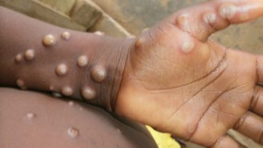 Monkeypox in India: దేశంలో మంకీపాక్స్‌ తొలి కేసు, ఈ లక్షణాలు ఉంటే మీకు Monkeypox వైరస్ సోకినట్లే, మంకీపాక్స్‌ను మహమ్మారిగా ప్రకటించింన ప్రపంచ ఆరోగ్య సంస్థ