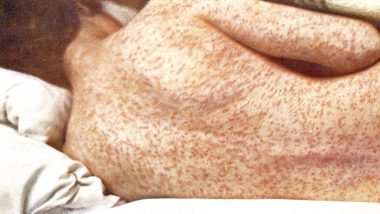 Measles Surge in US: అమెరికాలో మీజిల్స్ కల్లోలం.. 1991 తర్వాత ఇదే అత్యంత దారుణంగా పరిస్థితి.. ఒక్క పెన్సిల్వేనియాలో 1,000 దాటిన కేసులు..