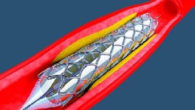 Coronary Stent: హృద్రోగులకు శుభవార్త.. ఇకపై అందుబాటులో ‘కరోనరీ స్టెంట్’..  జాతీయ అత్యవసర ఔషధాల జాబితాలో కరోనరీ స్టెంట్‌ను చేర్చిన కేంద్రం.. స్టాండింగ్ నేషనల్ కమిటీ ఆన్ మెడిసిన్స్’  సిఫార్సుల మేరకు నిర్ణయం.. జాబితాలో కొత్తగా చేరిన 34 మందులకు ఇది అదనం