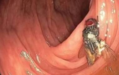 Fly Found Inside Man's Intestines: వృద్ధుడి పెద్దపేగులోకి చేరిన ఈగ, లోపలికి వెళ్లిందో తెలియక బుర్రలు బద్దలుగొట్టుకుంటున్న వైద్యలు