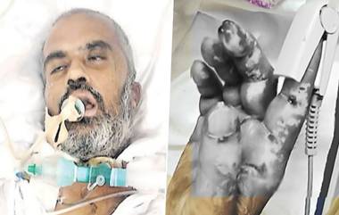 Kamareddy Horror: కామారెడ్డి ప్రభుత్వ ఆసుపత్రిలో ఘోరం.. ఐసీయూలోని రోగి చేతిని కొరికిన ఎలుకలు