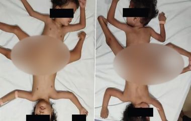 Twins Born In 4 Arms, 3 Legs: నాలుగు చేతులు, మూడు కాళ్లతో పుట్టిన కవలలు, ఈ అవిభ&zwnj;క్త క&zwnj;వ&zwnj;ల&zwnj;లపై డాక్టర్లు ఏమంటున్నారంటే..